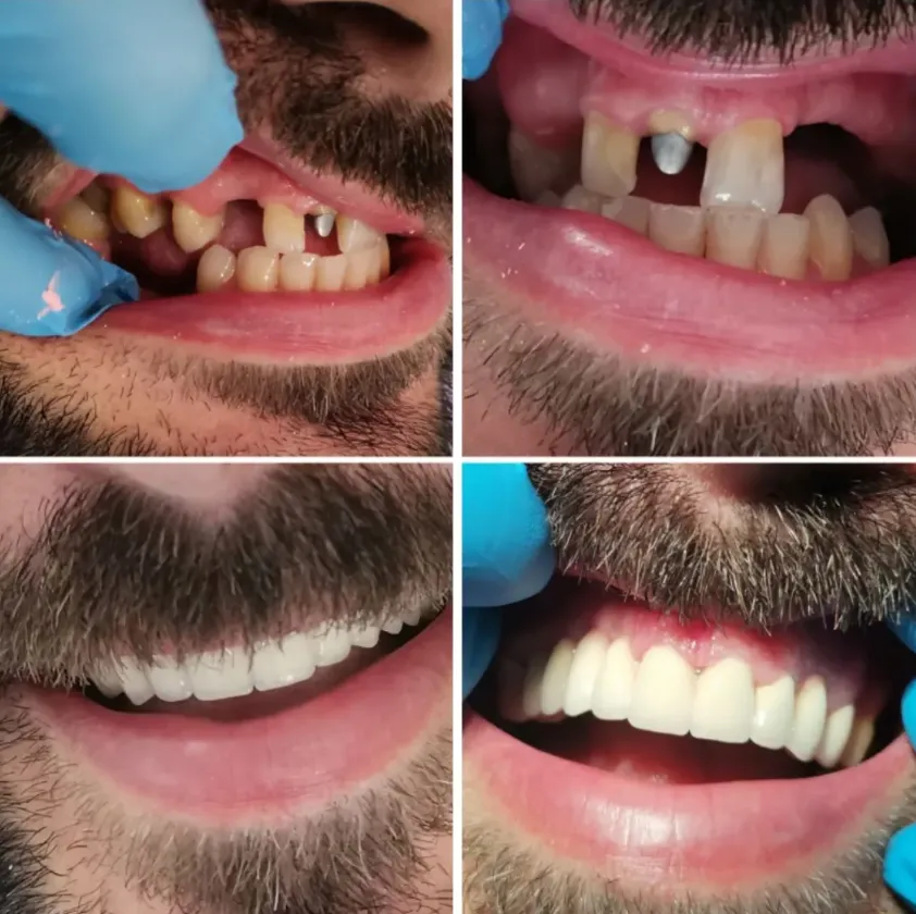 Prije i poslije — rad iz DD Dent laboratorije
